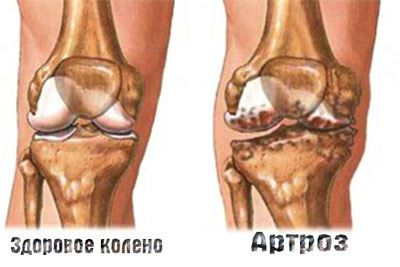 Болі в колінному суглобі лікування медикаментозними і народними засобами