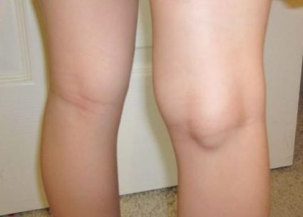 Біль під коліном ззаду причини і лікування