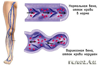 Venele acnee pe picioare, cauze, tratament, cauze, venă pe picior