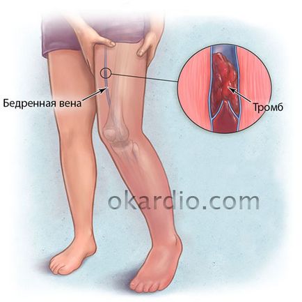 Inflamații venoase asupra simptomelor picioarelor, ce trebuie făcut, boli posibile, prognostic