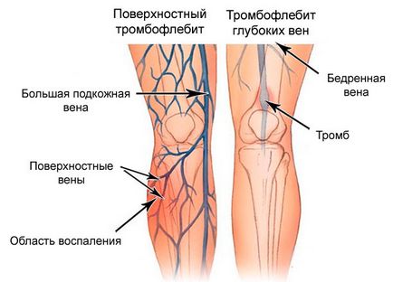 Болять вени на ногах симптоми, що робити, можливі хвороби, прогноз