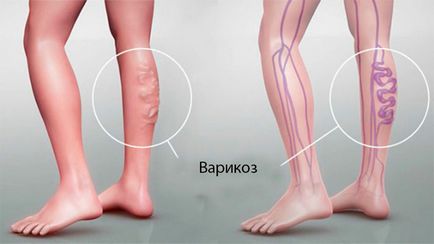 Болять вени на ногах симптоми, що робити, можливі хвороби, прогноз