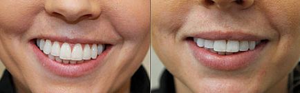 Botox ajkak hasonló módon ható, hogy mennyibe kerül, vélemények és fotók