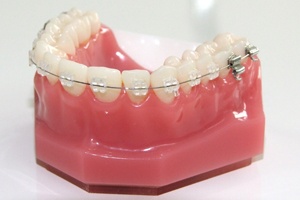 Braces sl tisztaság (Clarity) St. Petersburg, fotók, árak egyértelműség rögzítő rendszer (árak) Melles egyértelműség sl (Clarity) St. Petersburg, fotók, árak fogszabályozó egyértelműség