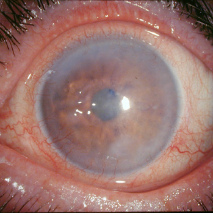 Бульозна кератопатія рогівки ока причини і лікування