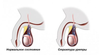 Бужування уретри у чоловіків (розширення)