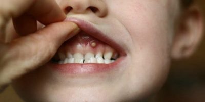 Ce să faceți dacă există un cos peste dintele de pe gingie