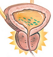 Ce vă împiedică să utilizați - movalis - cu prostatită