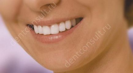 Care este acumularea dintelui pe pin și cum se întâmplă?