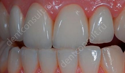 Care este acumularea dintelui pe pin și cum se întâmplă?