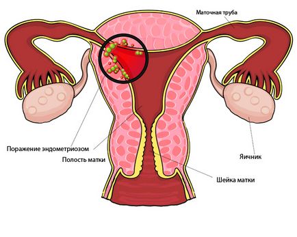 Eco în endometrioză, care sunt șansele și particularitățile procedurii