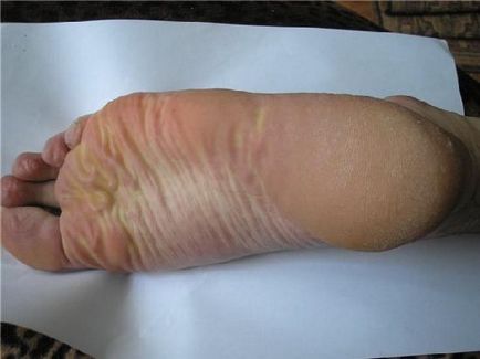 Eczemă pe mâini - mai mult de 10 ani de chin