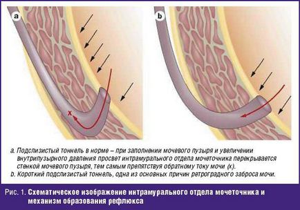 Corecția endoscopică a refluxului vesicoureteral la copii