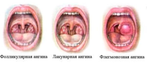 Foliculare în gât fără tratament de temperatură (fotografie)