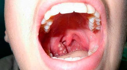 Folicularul inflamat cauzează gât, simptome și tratament