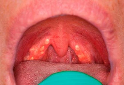 Folicularul inflamat cauzează gât, simptome și tratament
