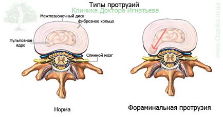 Foraminalis kiemelkedés (dorzális-foraminalis) - diagnosztizálása, kezelése »spine❺