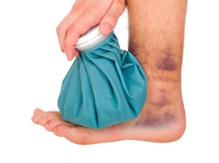 Гематома на нозі після удару симптоми і лікування
