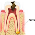 Hematom după înțelepciunea extracției dentare, stomatologie