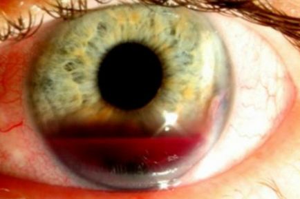 Hyphema (hemoragie în camera anterioară a ochiului) ce este, simptome, cauze, tratament (picături și