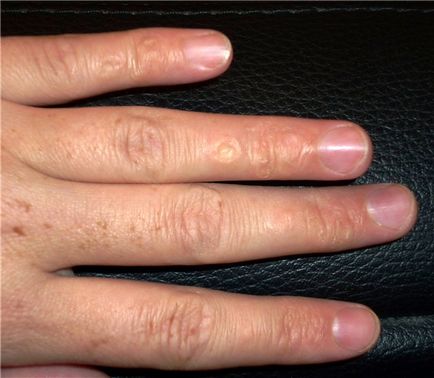 Грибок кистей рук симптоми причини лікування і фото