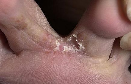 Ciuperca pe picioarele otetului și alte remedii pentru tratamentul ciupercilor piciorului la domiciliu
