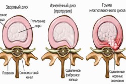 Hernia pe simptomele coccisului