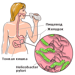 Helicobacter pylori і його вплив на організм людини