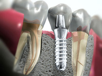 fogászati ​​implantátumok