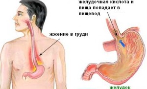 Arsuri la stomac în gât - cauze și simptome ale debutului