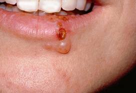 Cum de a scăpa rapid de herpes, răni, blistere pe buze, tratament, vindeca herpes rapid
