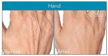 Hogyan húzza meg a bőrt a kézen