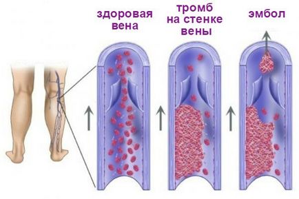 Як запобігти тромбофлебіт і варикозне розширення вен!