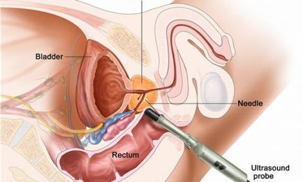 Cum se realizează hipertrofia de prostată?