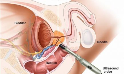 Як проводиться ТРУЗІ передміхурової залози