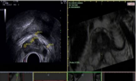 Як проводиться ТРУЗІ передміхурової залози
