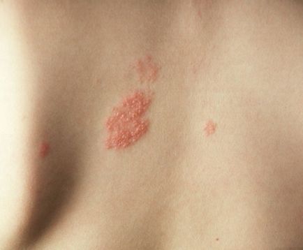 Cum să vindeci lichenul pe corpul uman