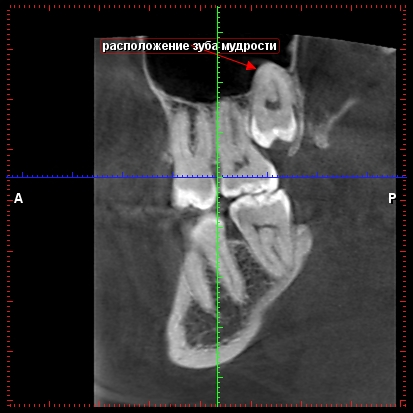 Cone-beam komputertomográfia - Dental Clinic SAD