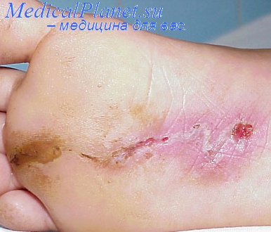 Шкірна форма синдрому блукає личинки (larva migrans) - діагностика, лікування