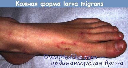 Шкірна форма синдрому блукає личинки (larva migrans) - діагностика, лікування