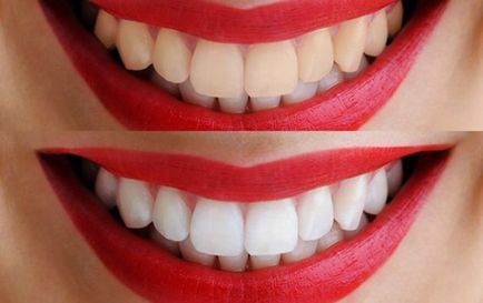 Etapele de albire a dinților laser și contraindicații