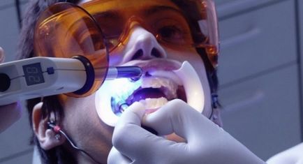 Etapele de albire a dinților laser și contraindicații