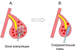 Лікування риніту лазером