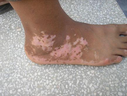 Tratamentul vitiligo cu cremă pentru copii și ulei de arbore de ceai