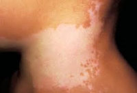 Tratamentul vitiligo cu remedii folk aplicarea de oțet, chimen și ulei esențial la domiciliu