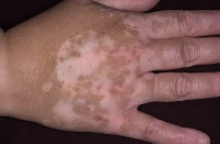 Tratamentul vitiligo cu remedii folk aplicarea de oțet, chimen și ulei esențial la domiciliu