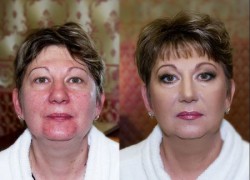 Lifting-make-up rezolvă probleme fără operațiuni