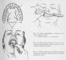 Metode de anestezie a maxilarului superior, stomatologie terapeutică