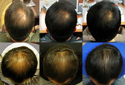 Mezoterápia szőrnövekedés véleménye, fotók előtt és után, javallatok és ellenjavallatok, gyógyszerek