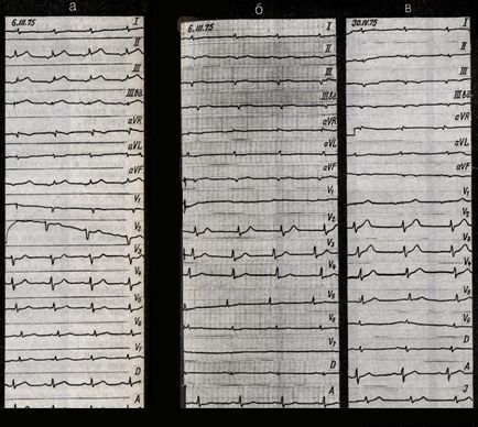 Infarct miocardic multifocal - tratament cardiac